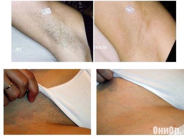 Fito Depilation результат