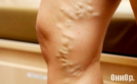 Варикозное расширение вен