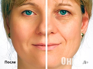 до и после Neolida